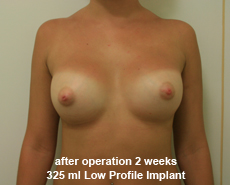 plastic-surgery-breast-augmentation